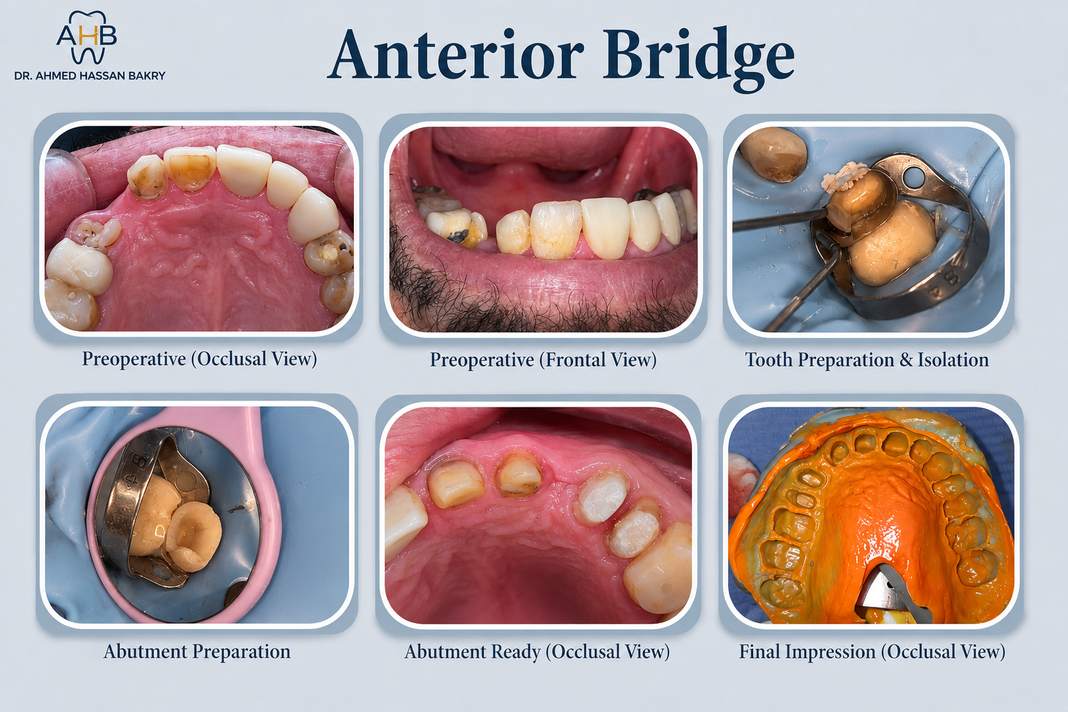Anterior Bridge
